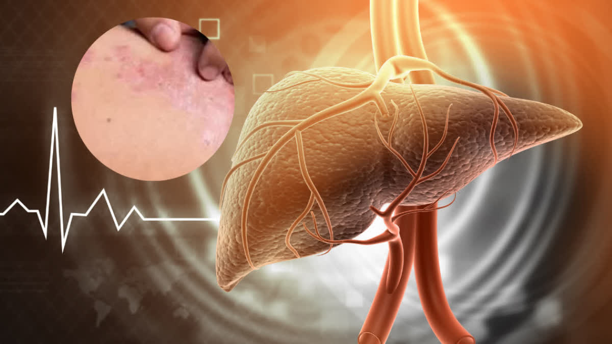 LIVER के लिए खतरनाक है हेपेटाइटिस A, B और C, जानें किस स्टेज में लिवर ...