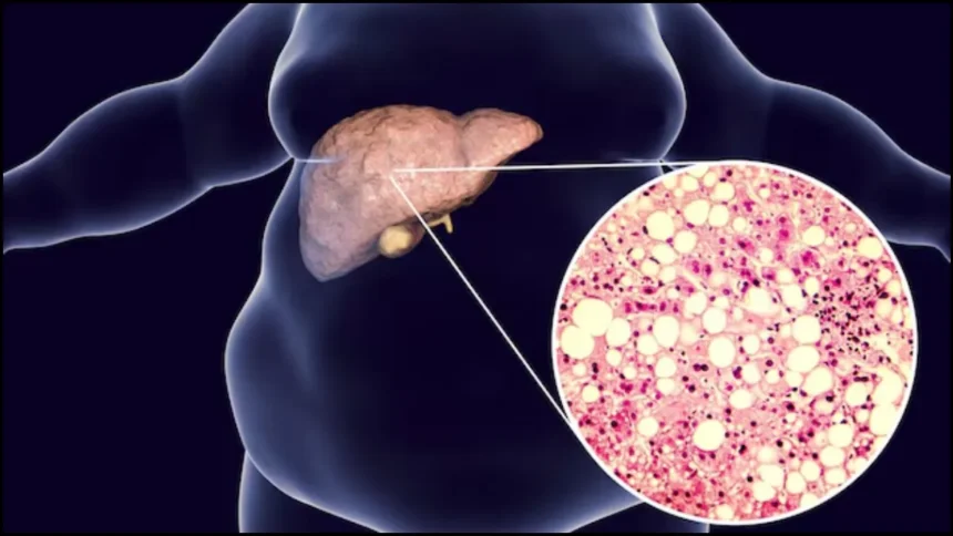 fatty liver spray 17 02 2026 1771316326